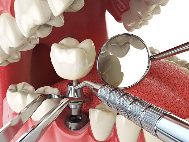 Best Chipped Tooth Repair Near Me  in Cut Off, LA
